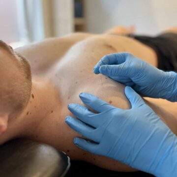 Zorgvuldige triggerpoint therapie tijdens fysiotherapie behandeling voor pijnverlichting en muscle ontspanning.