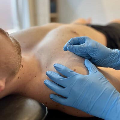 Zorgvuldige triggerpoint therapie tijdens fysiotherapie behandeling voor pijnverlichting en muscle ontspanning.